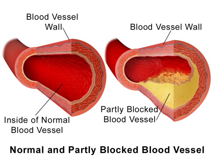 normal and partly blocked blood vessel