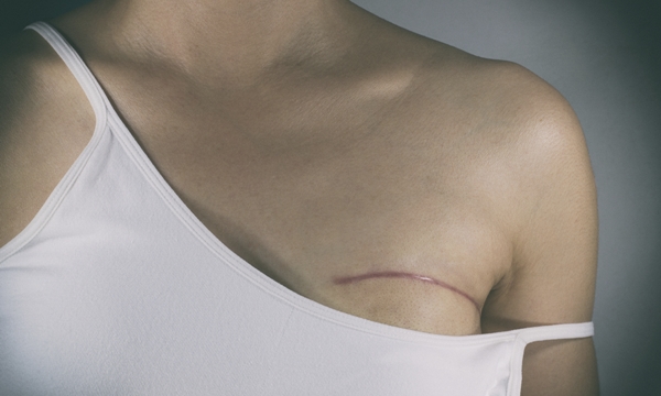 Breast cancer surgery scars by partial mastectomy. With effect filter.